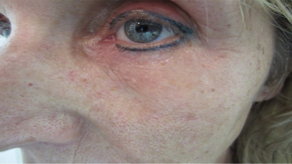 Malar nachher Dr. Kai Rezai Beauty Doc