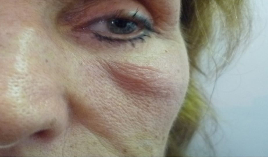 Malar Mounds Dr. Kai Rezai Beauty Doc