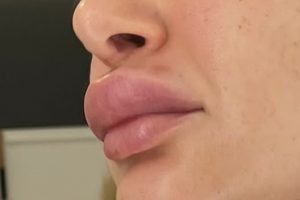 Lippenschwellung nach Hyaluron Filler